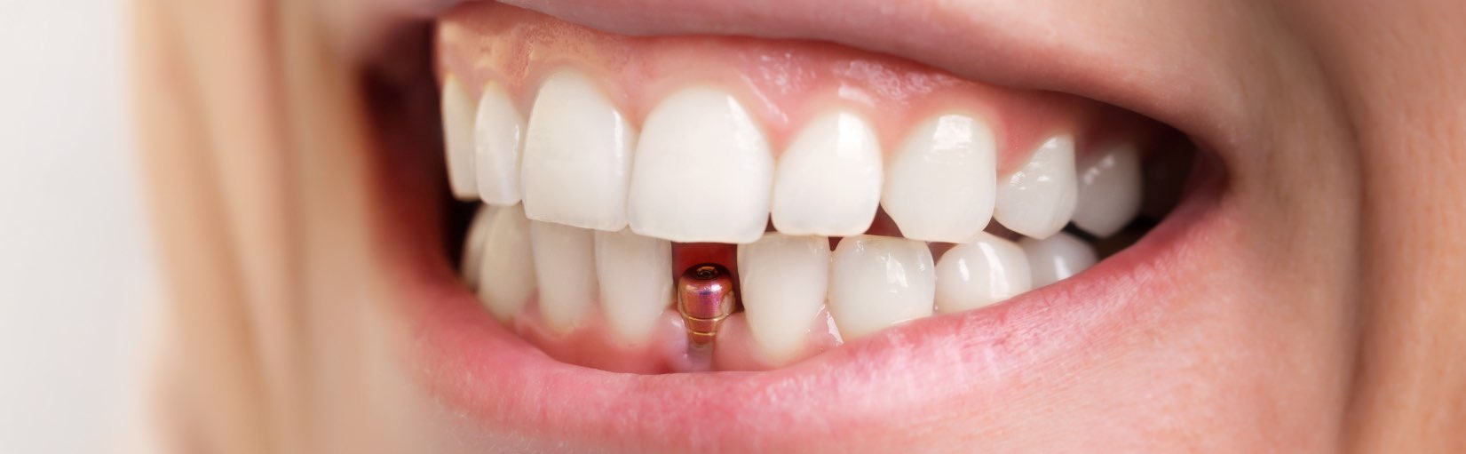 Studio Dentistico Rossi Zanon | Implantologia