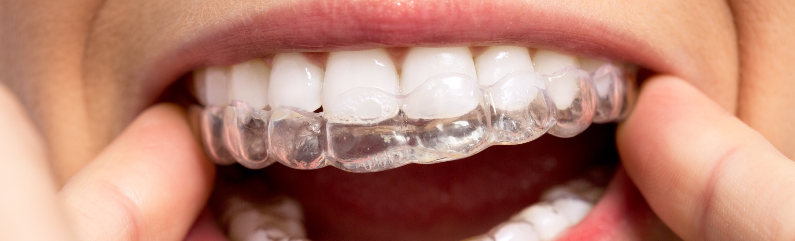 Studio Dentistico Rossi Zanon | Ortodonzia
